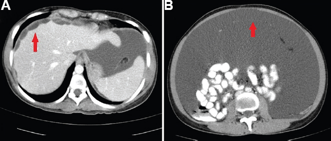 (A) Contrast-enhanced axial computed tomography images showing loculated ascites with multiple thin septae, scalloping of the liver (arrow) and (B) mild omental thickening (arrow).